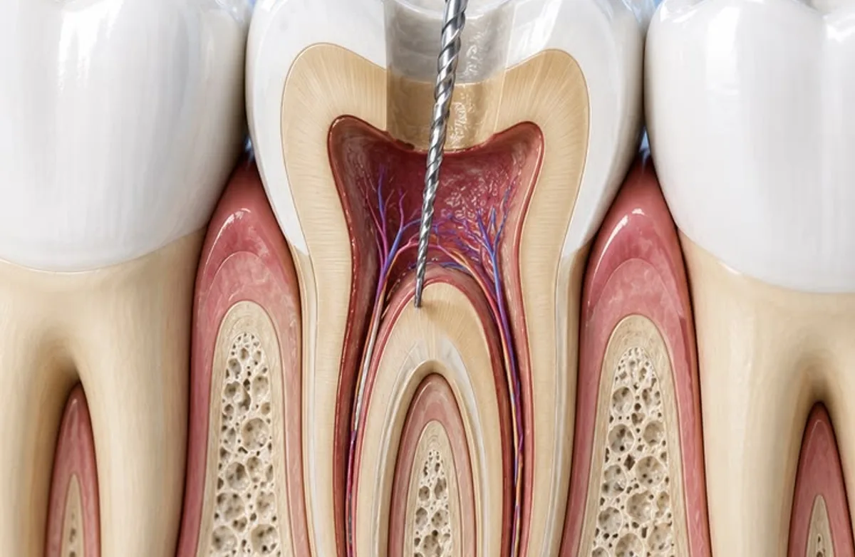 Cross-section illustration of a molar during root canal treatment, with an endodontic file cleaning the pulp chamber and root canal