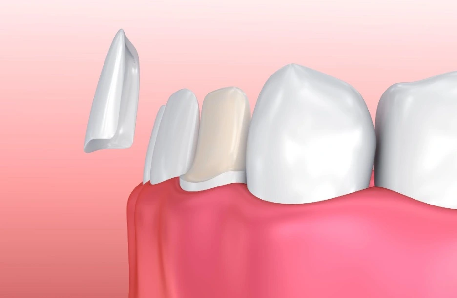 Dental Veneers in Ahmedabad