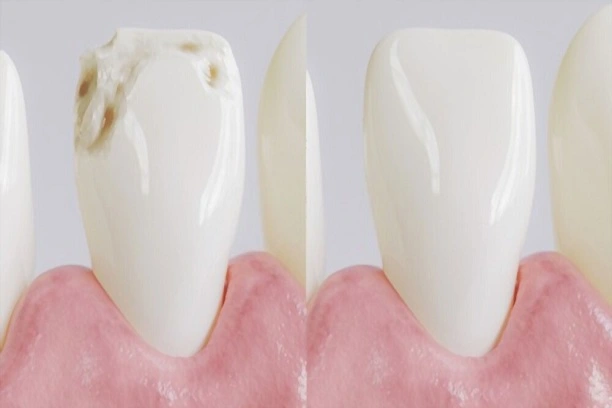 fluoride treatment