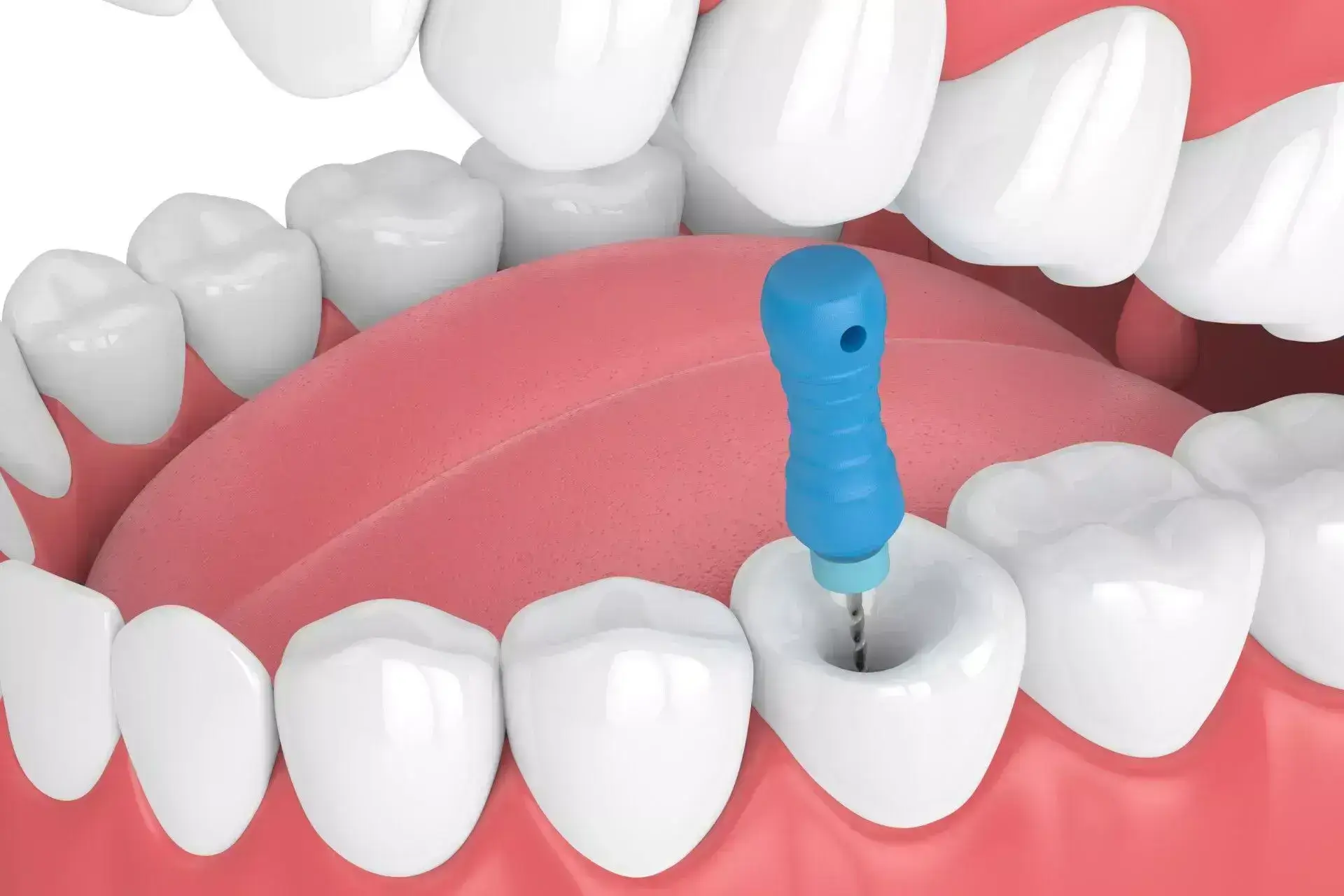 Root Canal Treatment in Ahmedabad