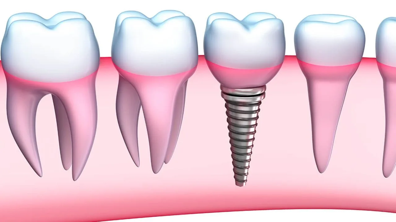 Dental Implants Treatment