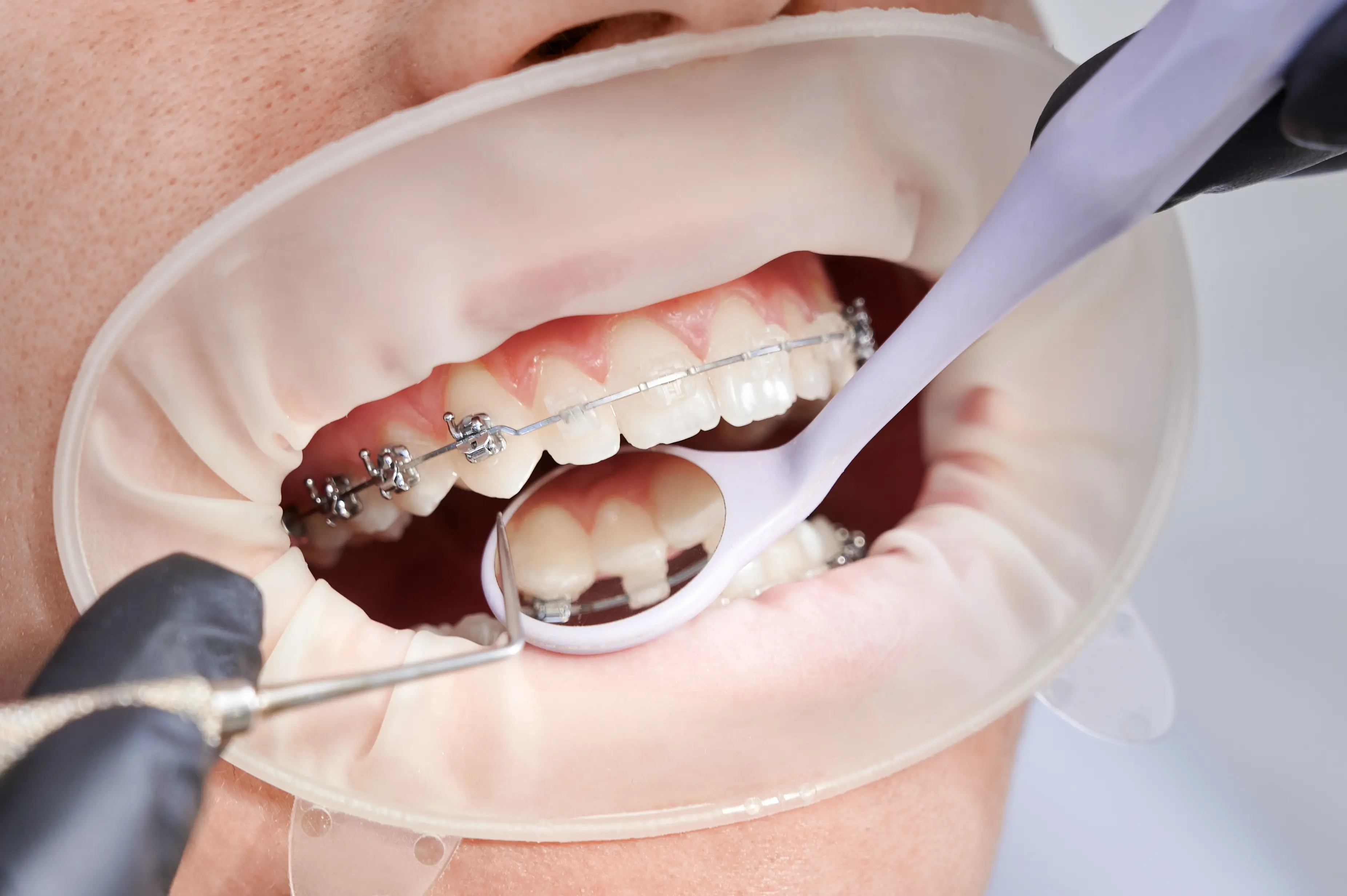 Teeth Braces treatment in Ahmedabad