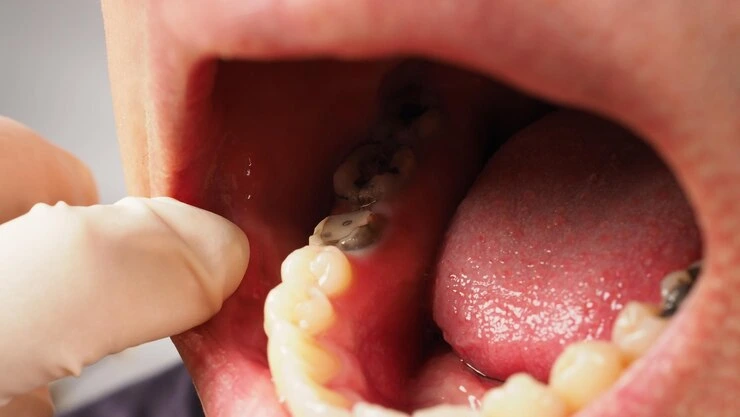 Tooth filling in Ahmedabad in Ahmedabad