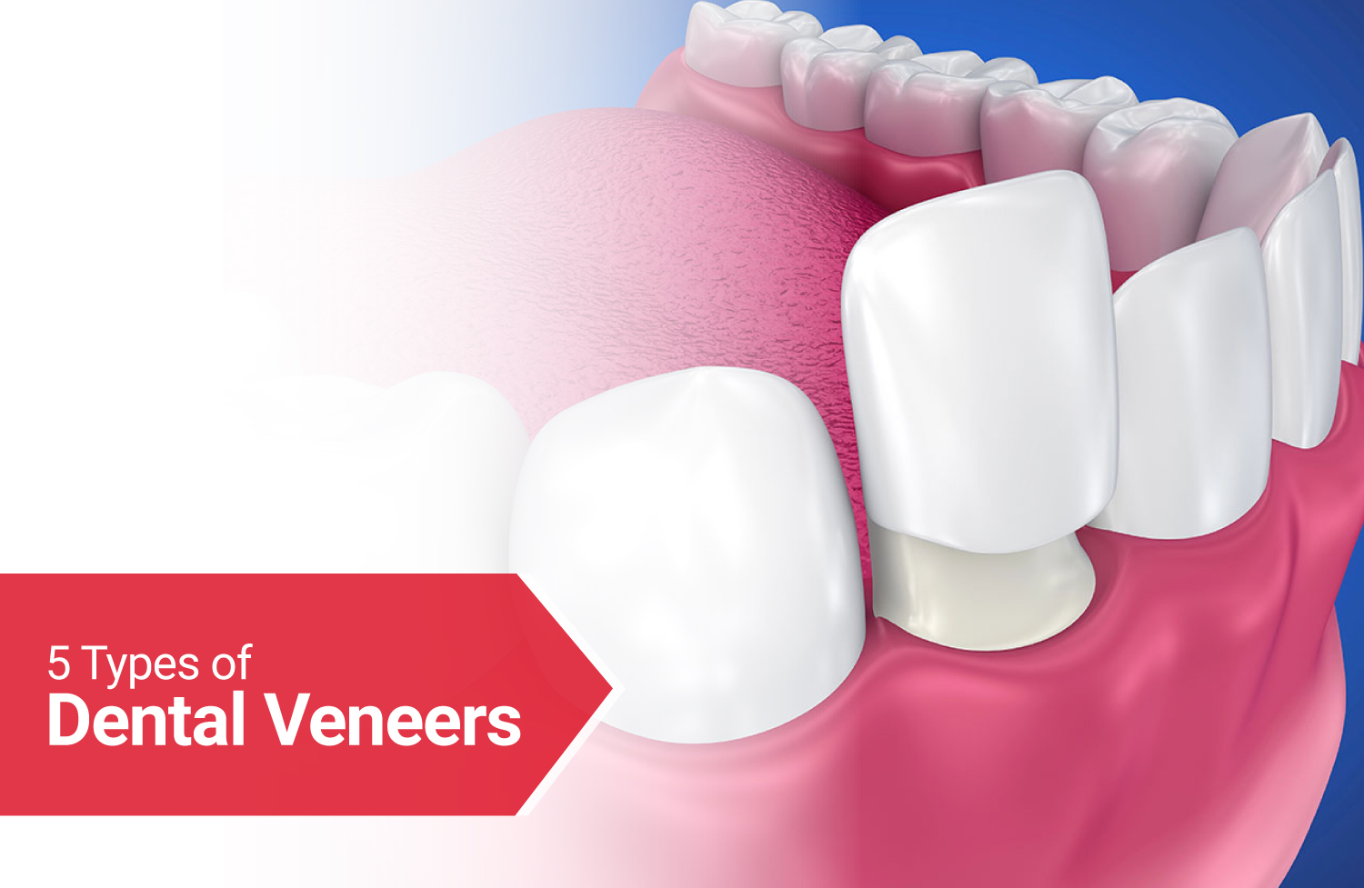 Types of Dental Veneers