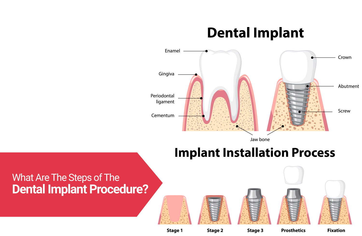 Types of Dental Veneers