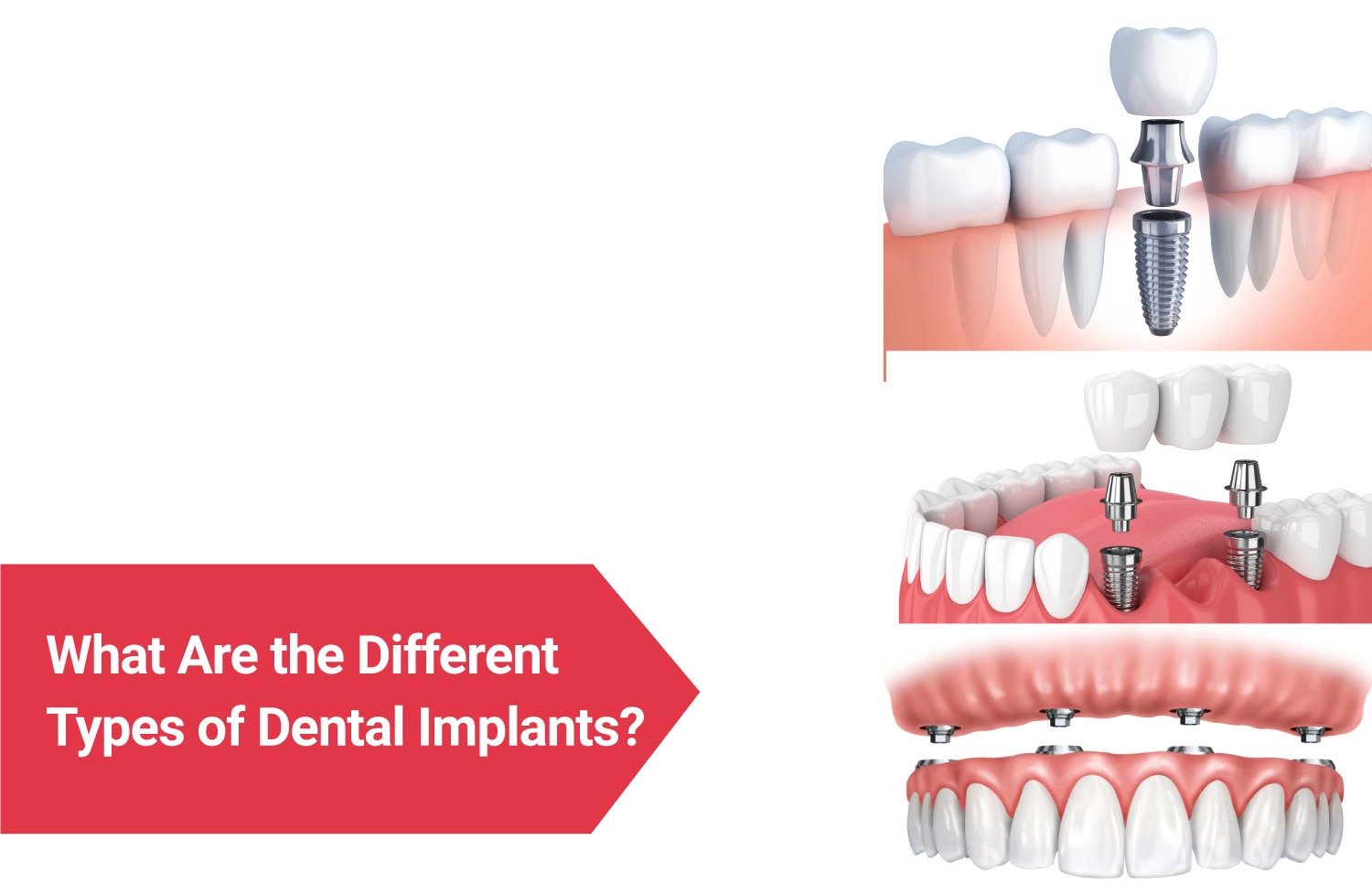 Types of Dental Implants