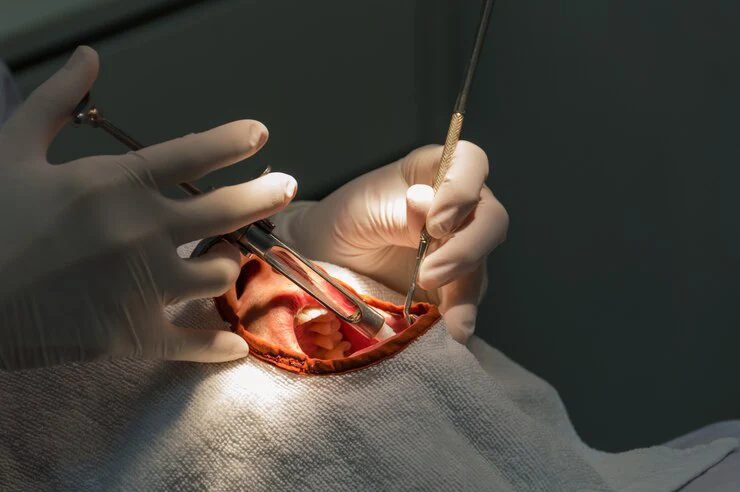Dental extraction Treatment in Ahmedabad