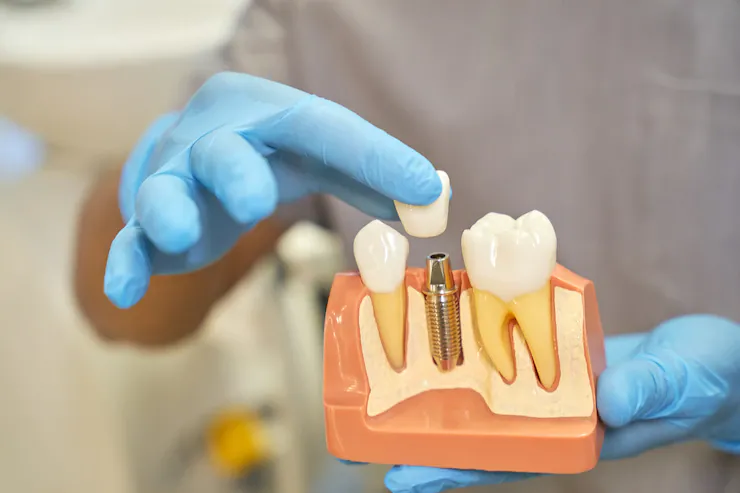 Teeth Implants