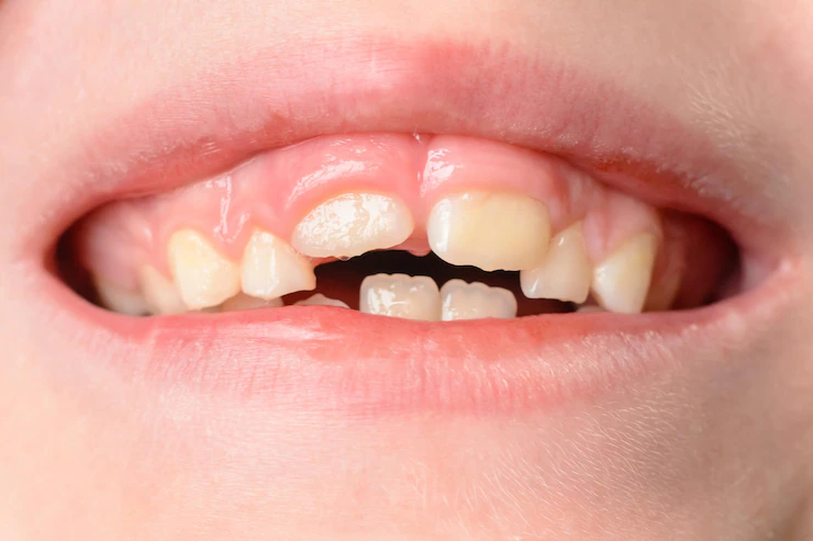 space maintainers Treatment in Ahmedabad