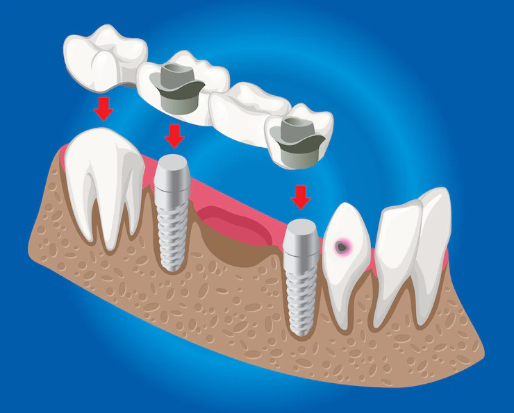 tooth bridge treatment in Ahmedabad