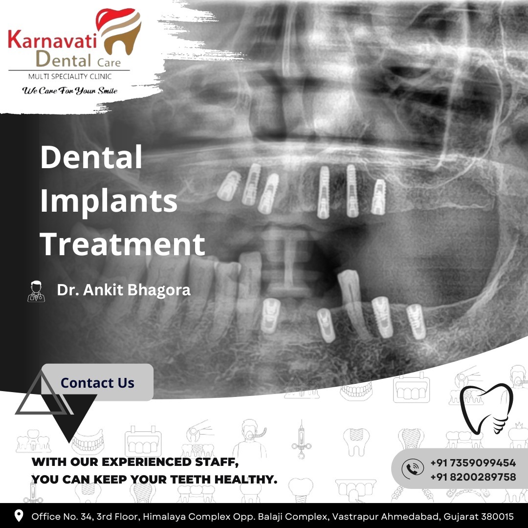 OPG X-ray showing implant-supported restorations in the jaw, of the kind used to plan dental implant treatment