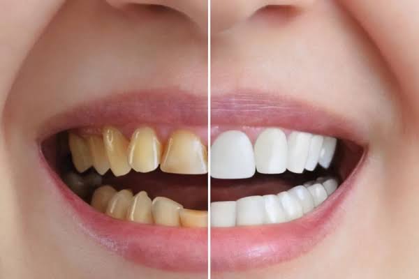 Fluoride varnish being applied to a patient's teeth at Karnavati Dental Care to strengthen the enamel against decay